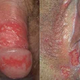 Illustration for article titled Cara Mengobati Penyakit Herpes kelamin